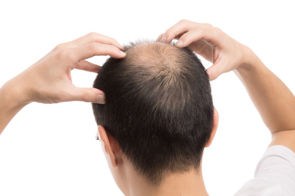 calvice, alopecia androgenética