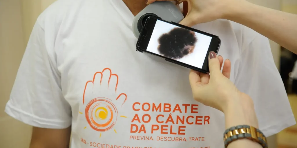 cancer de pele 