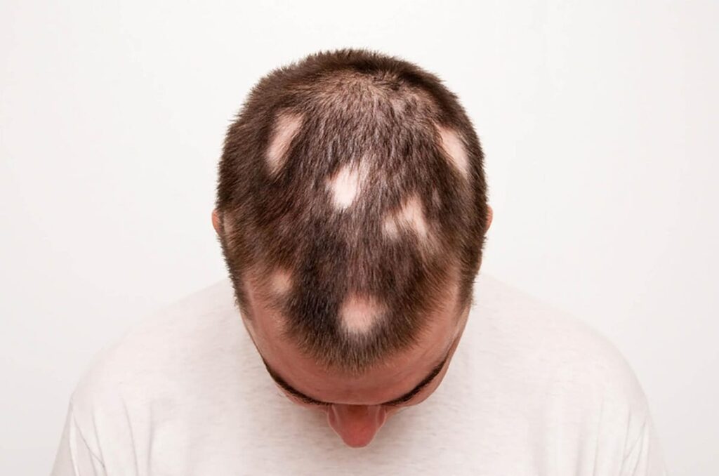 alopecia areata - queda de cabelo