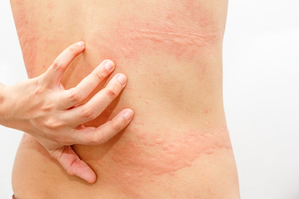 urticária, coceira no corpo