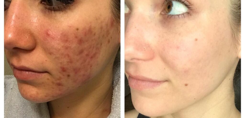 acne tratamento 
