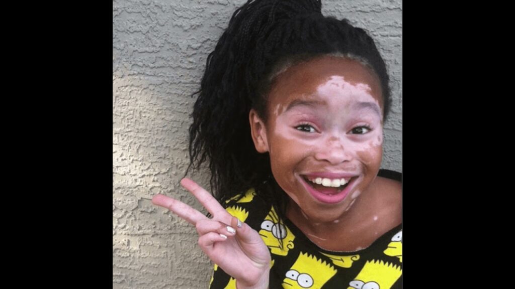 vitiligo 