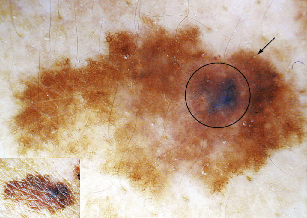 melanoma em pele